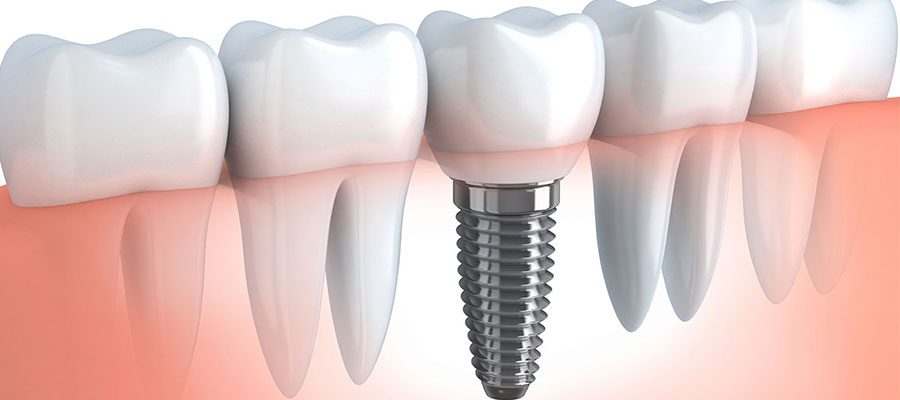 إجراءات زراعة الأسنان