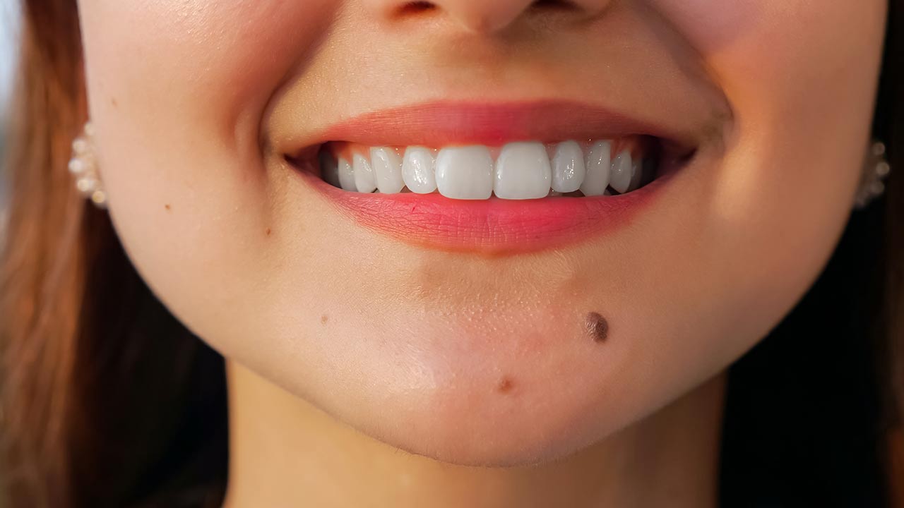 الأشخاص الذين يعانون من بقع سوداء على أسنانهم: معلومات مهمة