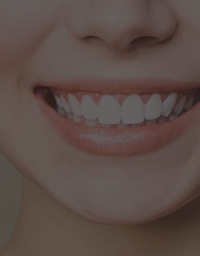 gummy smile