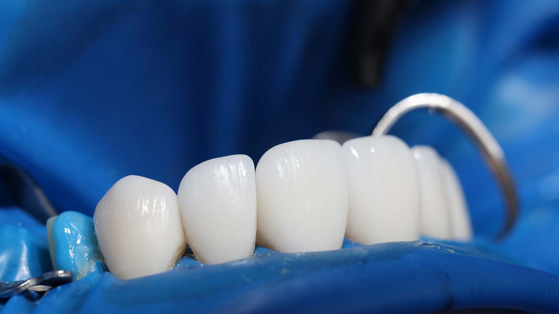 Zirconium Crowns in Istanbul Natural and Comfortable