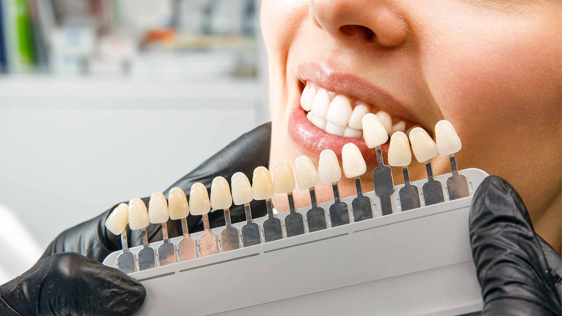 Zirconium tooth veneer, offering durable, natural looking solutions for a flawless smile.