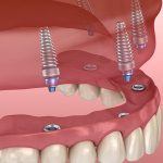 Experience All-on-4 dental implant treatment in Turkey, offering a comprehensive solution for full mouth restoration with Aliadent.