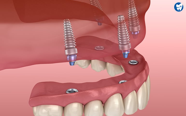 Experience All-on-4 dental implant treatment in Turkey, offering a comprehensive solution for full mouth restoration with Aliadent.