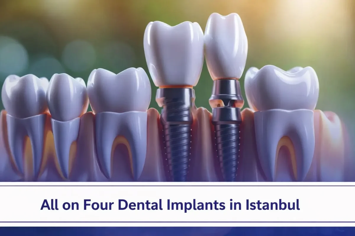 Explore all on four dental implants in Istanbul.