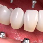 Explore various dental implant applications in Turkey, including single tooth replacement, full arch restoration, and implant-supported dentures.