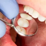 Learn about porcelain fillings, inlays, and onlays for durable and aesthetically pleasing dental restorations with Aliadent.