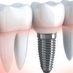 Learn about removable dentures, including total and partial options, for restoring missing teeth and improving oral function.