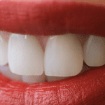 Experience zirconium crowns in Turkey, offering durable and aesthetically pleasing dental restorations for a confident smile.