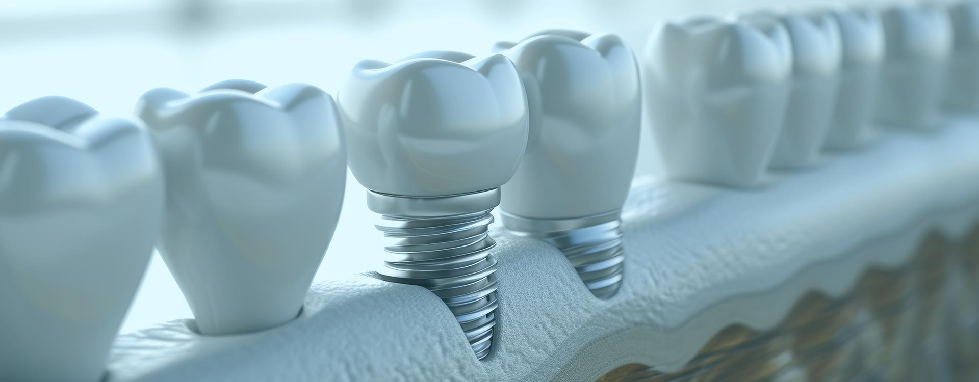 Benefits of dental implants in Istanbul, Turkey: High-quality care, advanced technology, and cost-effective solutions.