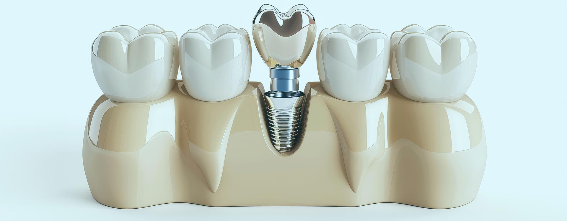 Procedure of dental implant Istanbul: Advanced techniques and high-quality care for a seamless and effective tooth restoration process.