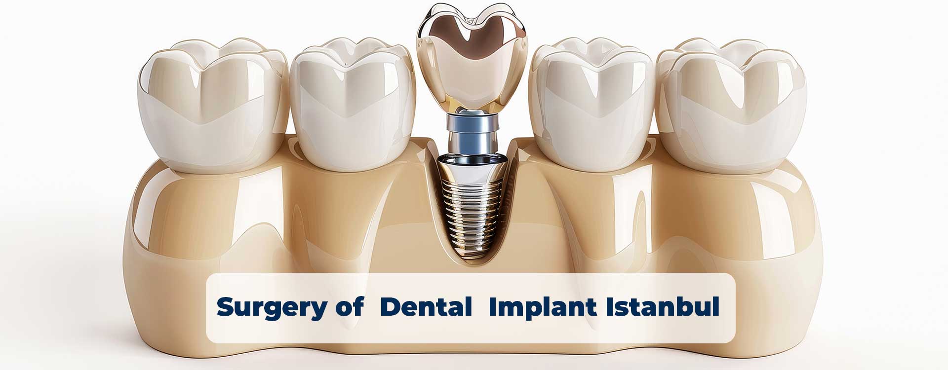 Surgery of dental implant Istanbul: Expert care and advanced surgical techniques for successful tooth restoration.