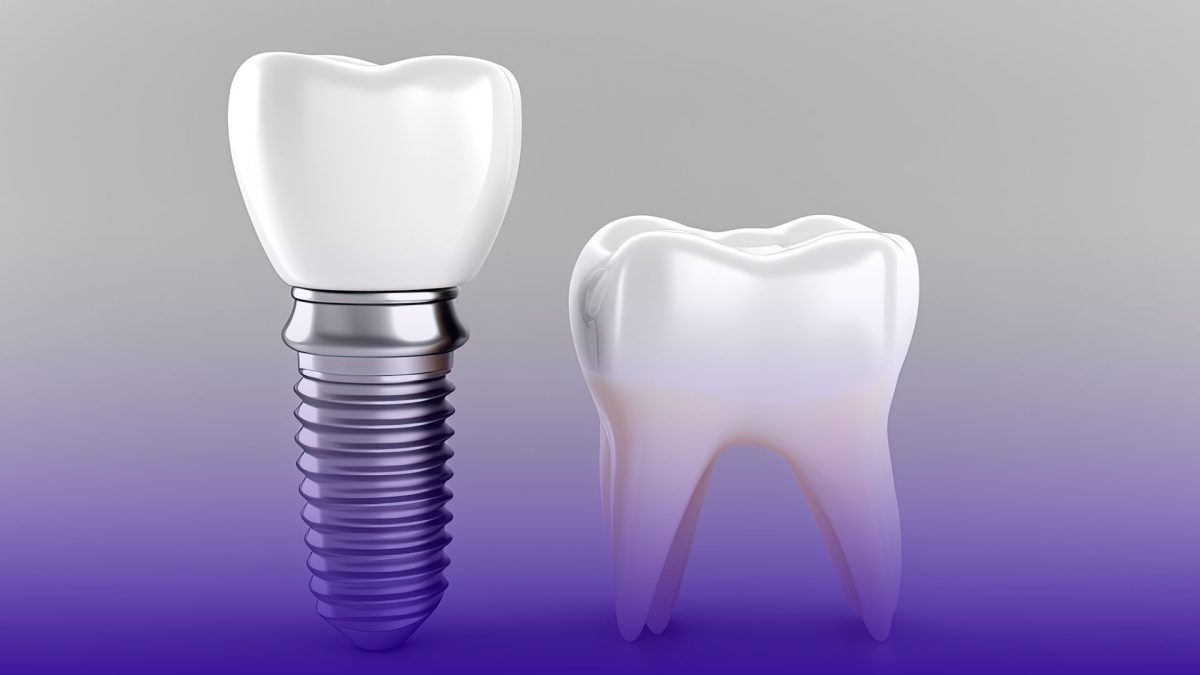 Best dental clinics for dental implants.