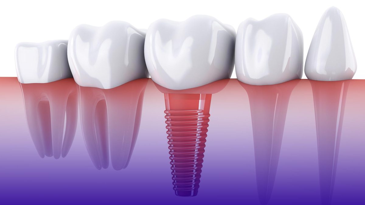 Dental implant costs in Istanbul.