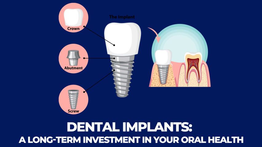 Dental implants in Istanbul: a long-term investment.