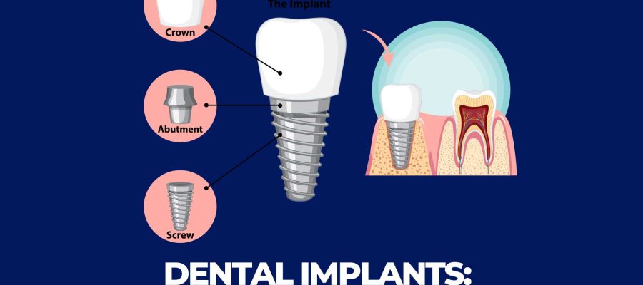 Dental implants in Istanbul: a long-term investment.
