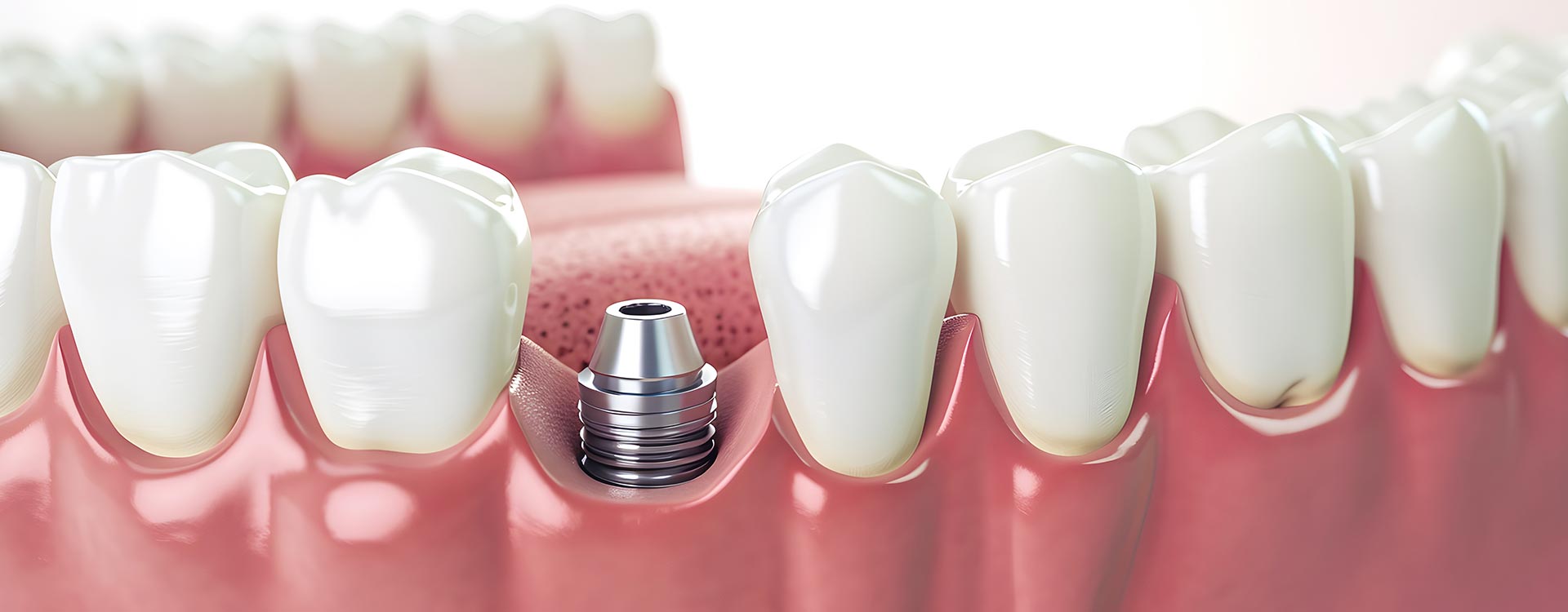 Discover tips for finding the best dentist in Turkey for dental implants, ensuring expert care and the use of advanced techniques for optimal results.