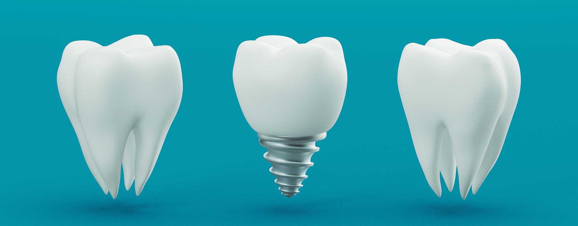 Power of Aliadent with dental implant Istanbul: Achieve a confident smile with our expert dental implant services at Aliadent Dental Health Center.