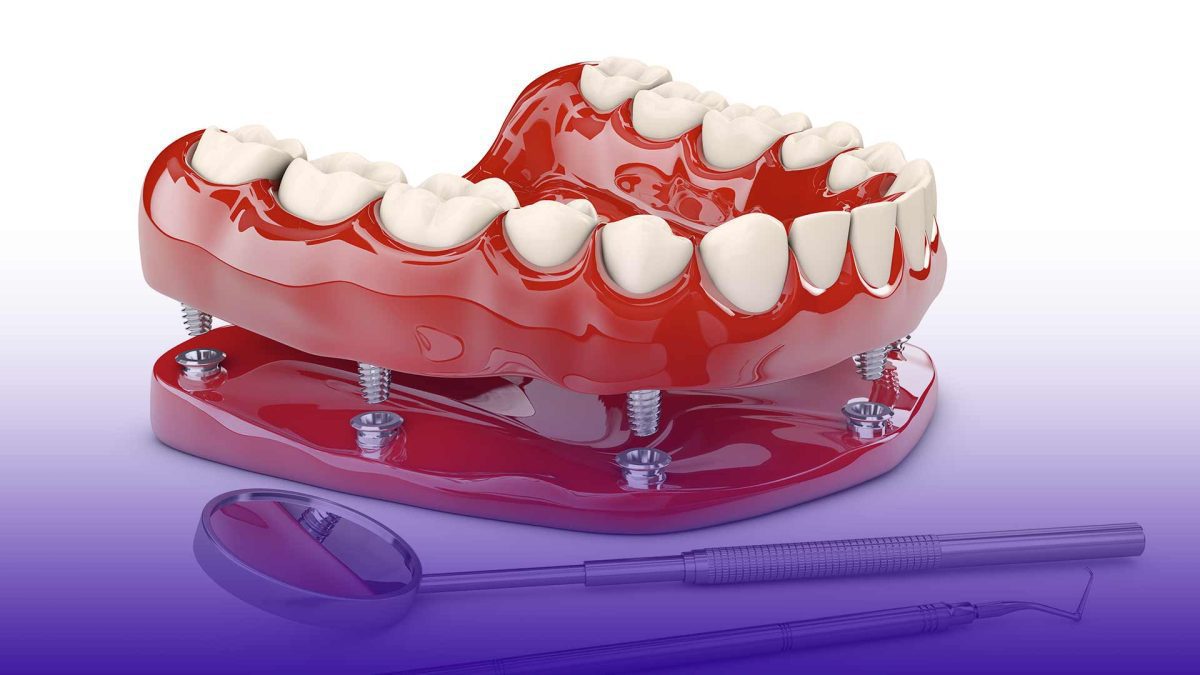 Why Istanbul is a top destination for dental implants.
