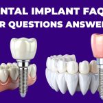 Dental implant FAQs with answers to common questions