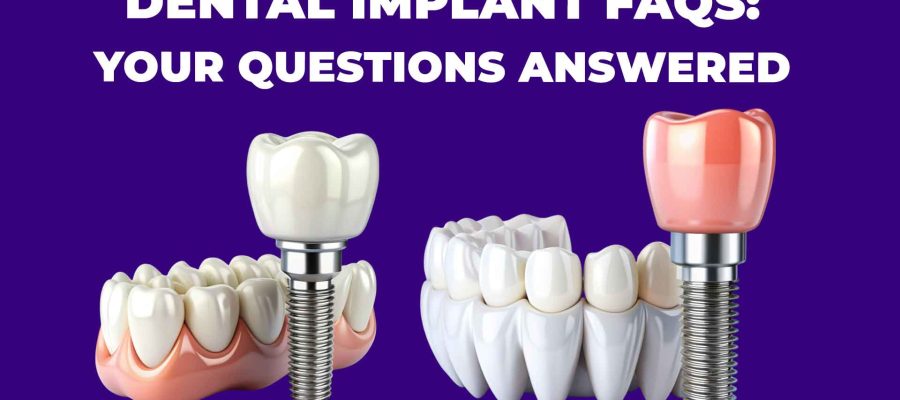 Dental implant FAQs with answers to common questions