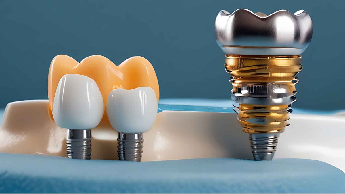 Comprehensive guide to dental implants