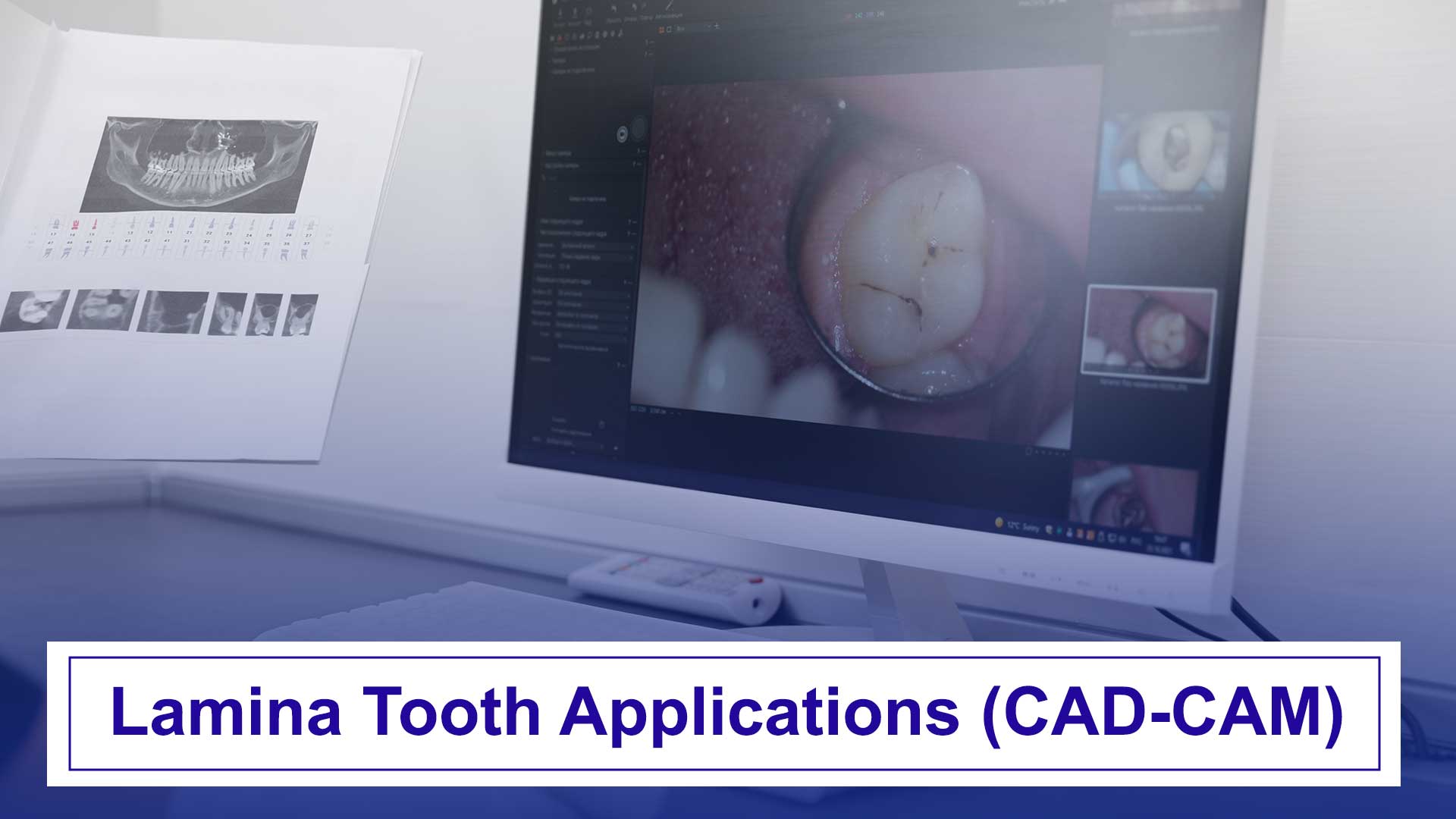 Lamina tooth applications using CAD/CAM technology for precise and aesthetic dental solutions.
