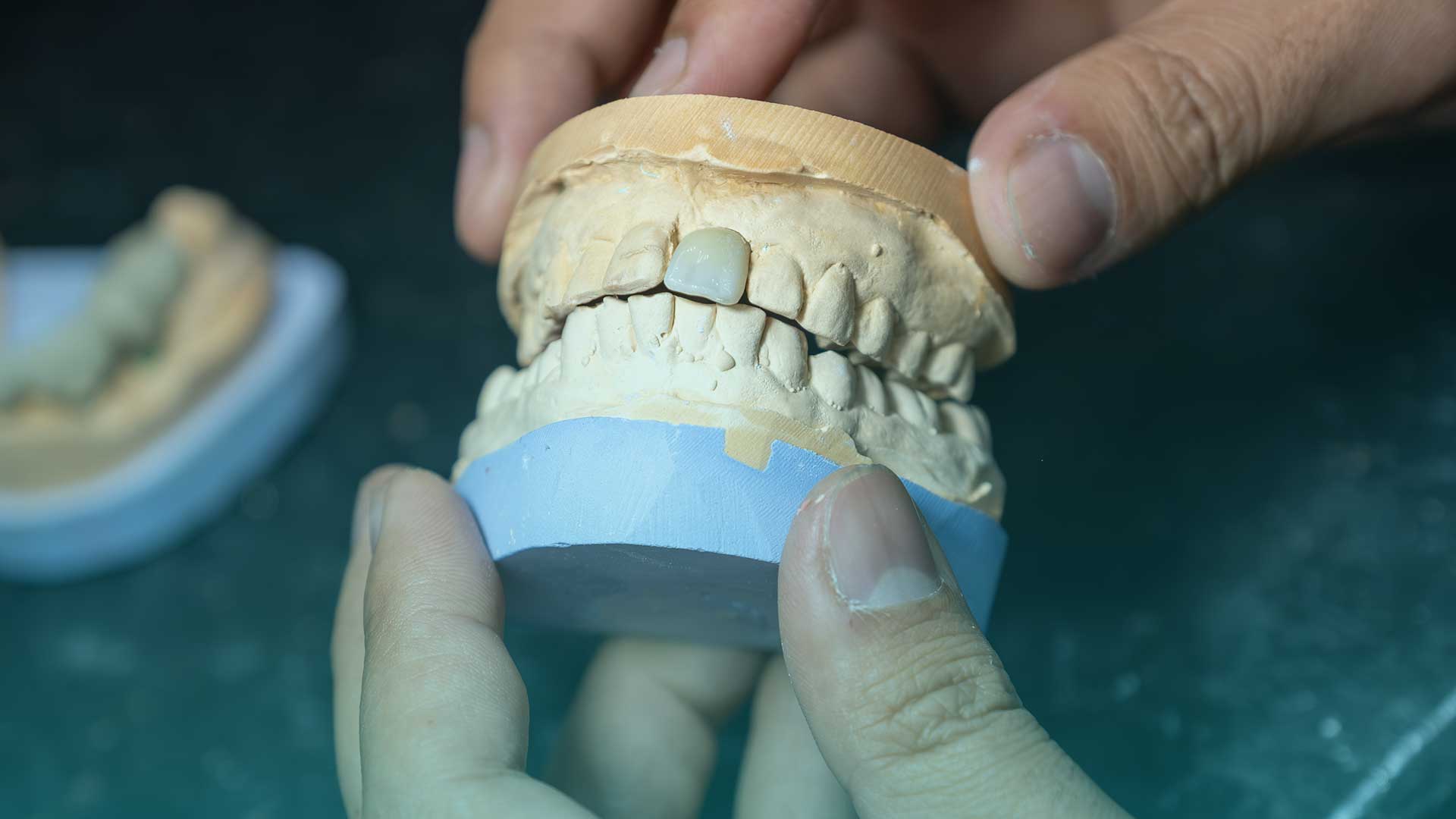 Partial removable prosthesis designed for restoring function and aesthetics