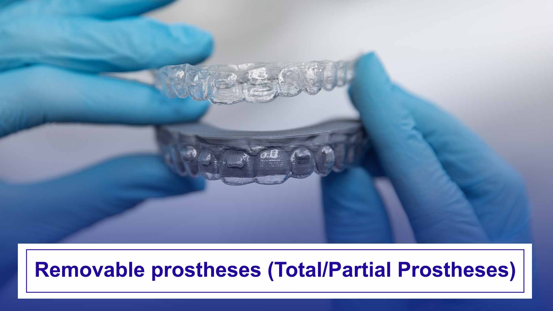 Total and partial removable prostheses for customized solutions in dental restoration.