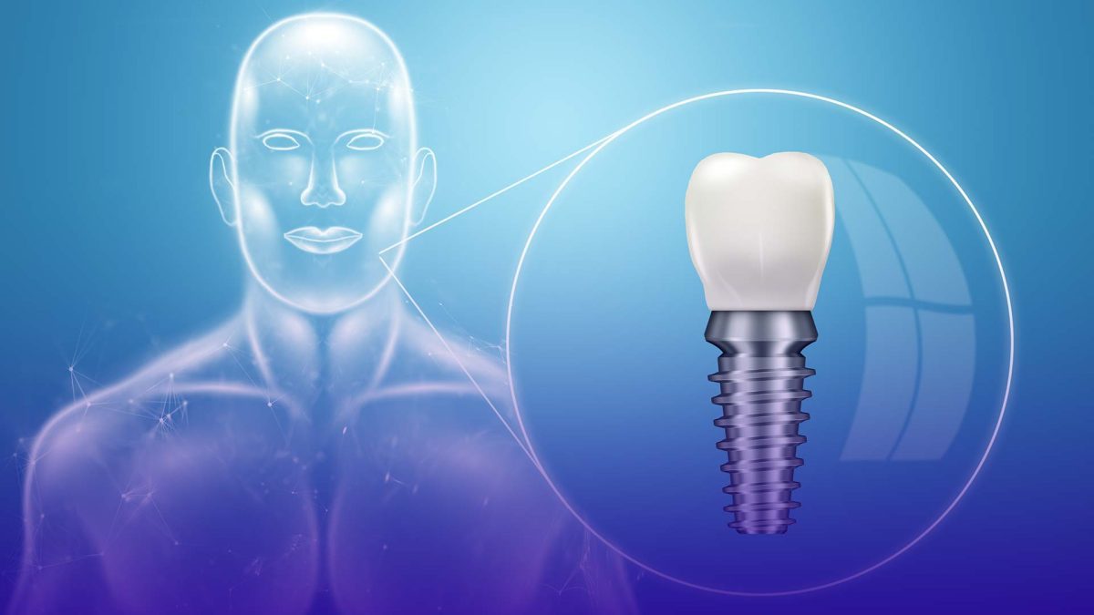 Addressing common fears about dental implants includes understanding the procedure, knowing the recovery process, and managing pain concerns.