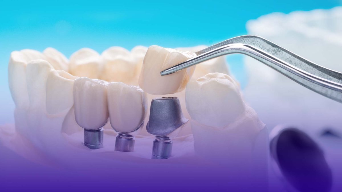 The benefits of dental implants in Istanbul and Turkey include high-quality care, affordable prices, and advanced technology.