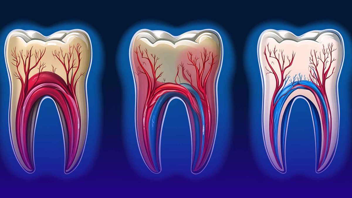 is root canal treatment really painful