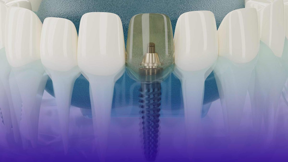 Techniques to overcome dental implant anxiety include deep breathing, sedation options, and discussing concerns with your dentist.