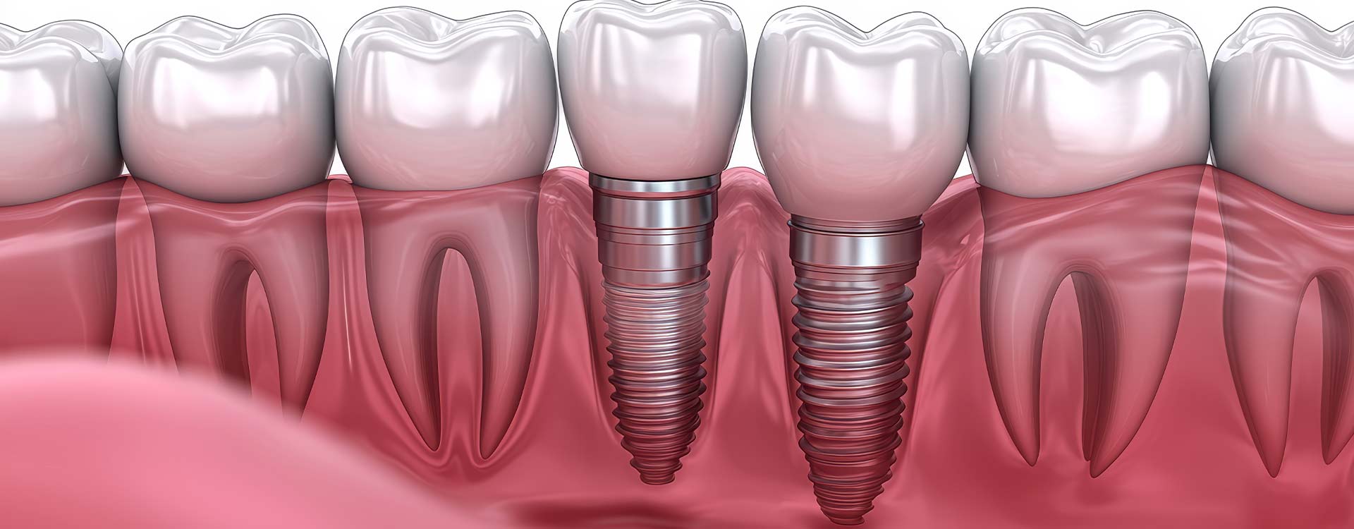 Learn more information about all on four dental implants Turkey.