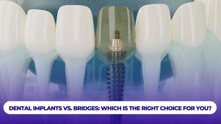 Dental implant vs dental bridges: Which is the right choice?