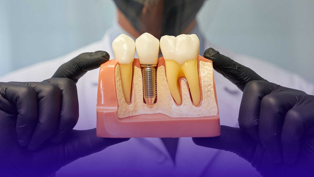 Dental implants in Istanbul: Why they are a popular choice.