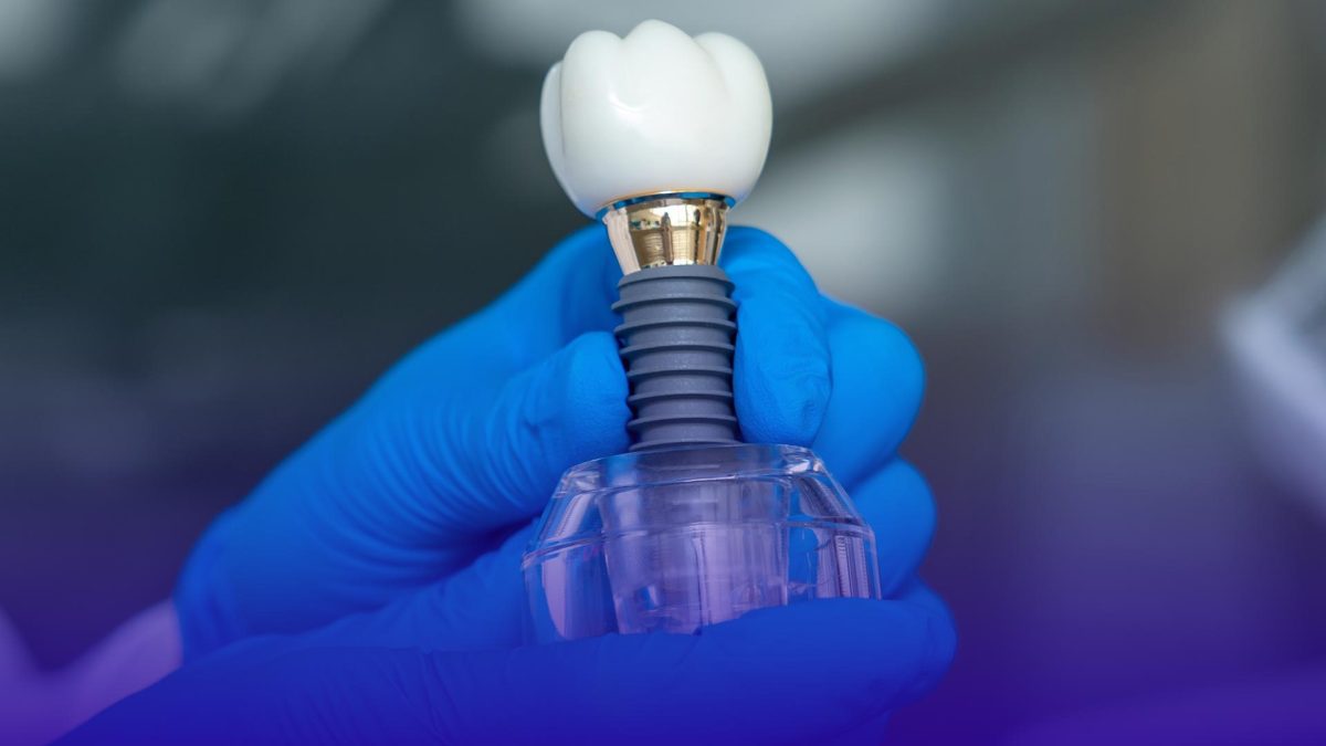 Factors to consider when choosing between implants and bridges.
