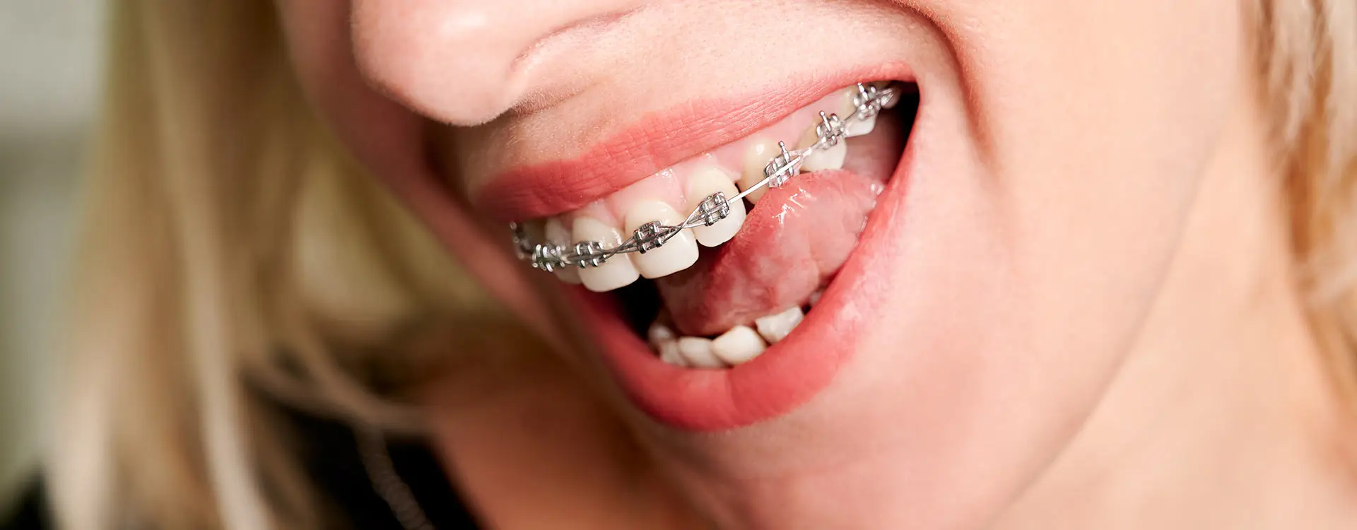 Fixed orthodontic treatment with Aliadent for effective teeth alignment and correction.