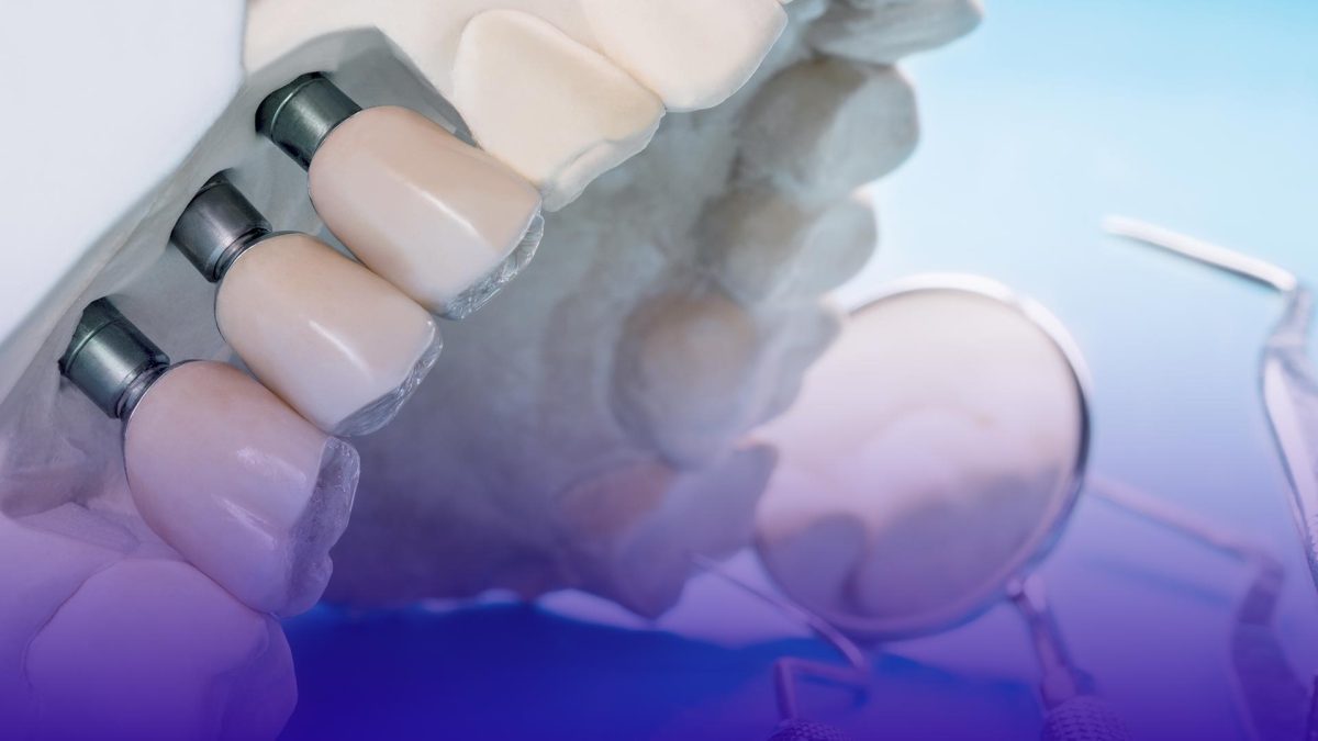Key differences between implants and bridges.