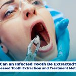 Can an Infected Tooth Be Extracted? Abscessed Tooth Extraction and Treatment Methods
