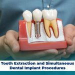 Tooth Extraction and Simultaneous Dental Implant Procedures