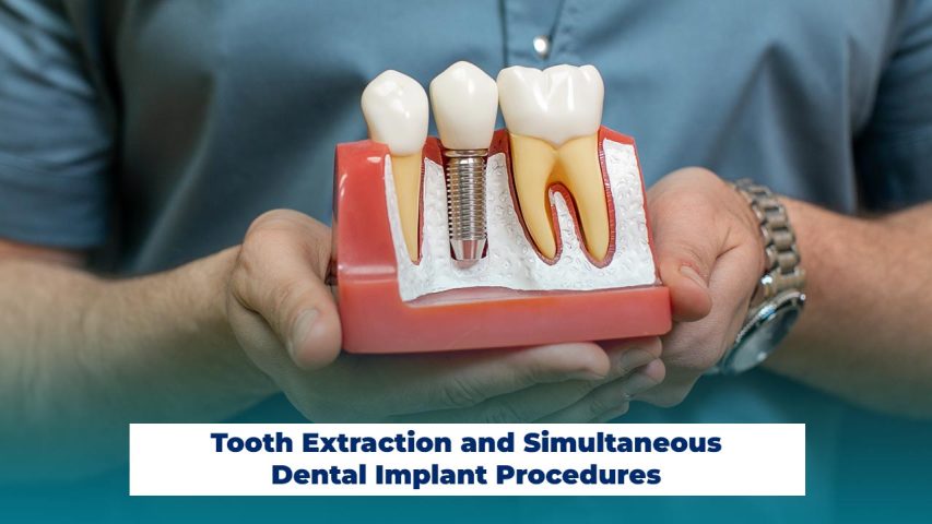 Tooth Extraction and Simultaneous Dental Implant Procedures