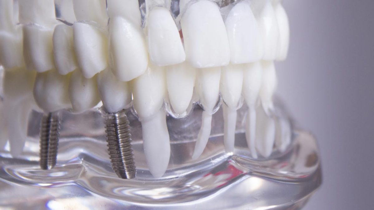 tooth extraction and simultaneous dental implant procedures ic1