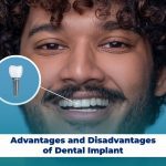 Advantages and Disadvantages of Dental Implant
