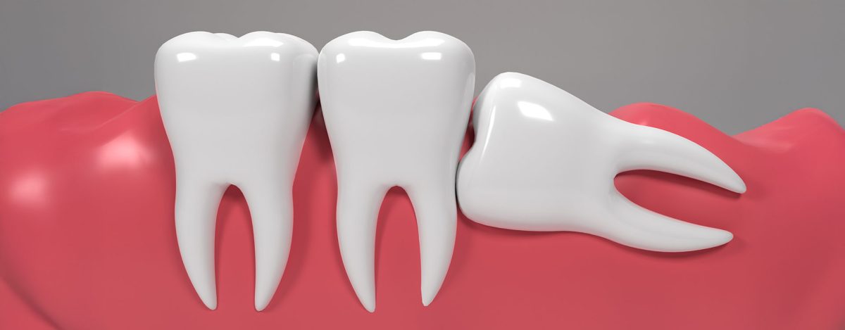What are Wisdom Teeth and Why Do They Need to Be Removed? 6 wisdom teeth extraction