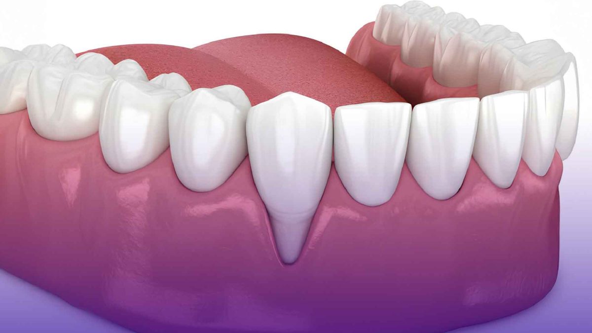 Discover effective tips on how to stop receding gums naturally and protect your smile today!
