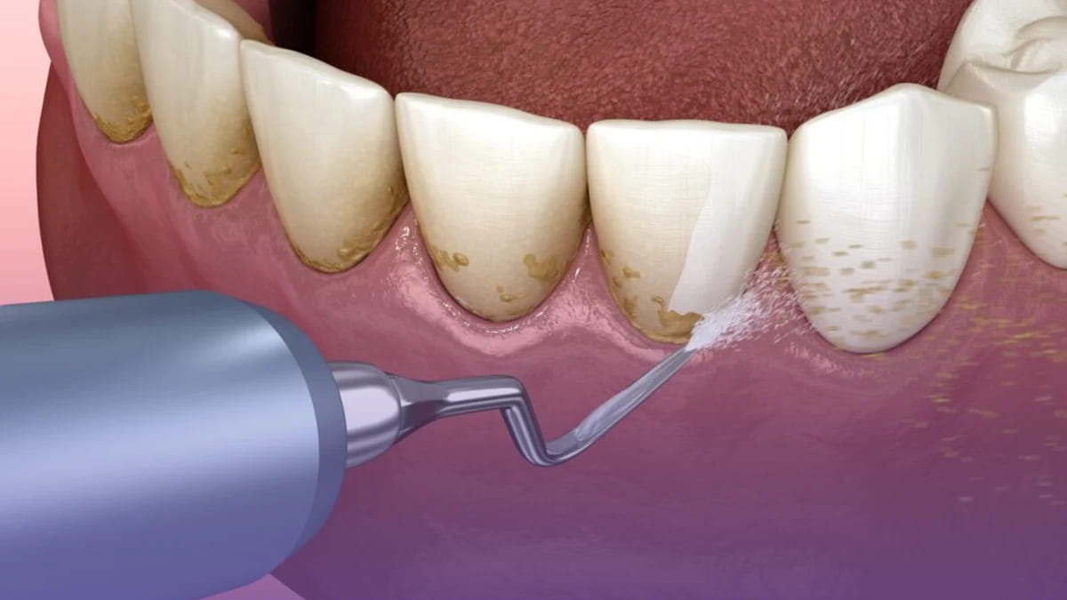 Plaque remover for teeth helps maintain oral hygiene by effectively eliminating stubborn plaque buildup.