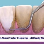 The Truth About Tartar Cleaning: Is It Really Necessary? 2 Professional tartar removal helps maintain healthy gums and prevents dental issues.
