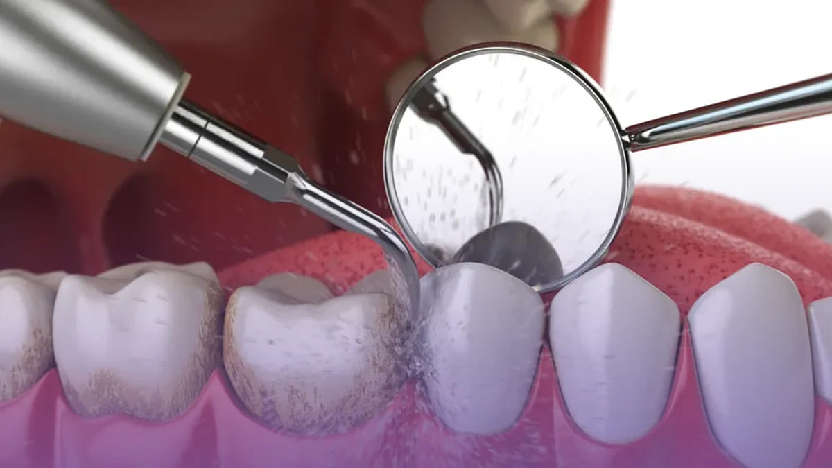 Ultrasonic plaque remover device effectively cleans teeth by removing plaque buildup for a healthier smile.