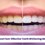 The 7 Best Fast Effective Teeth Whitening Methods 3 Find teeth whitening methods with Aliadent!