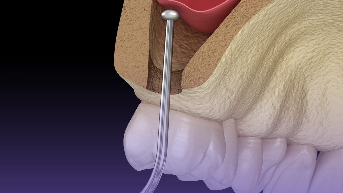 The role of sinus lift for implant is important.